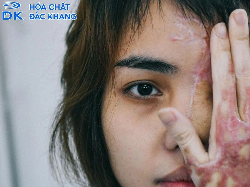 sơ cứu khi bị bỏng axit h2so4