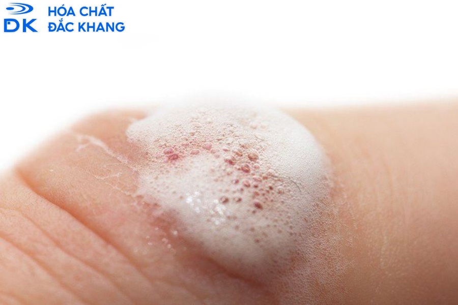 Tác Hại Của Oxy Già (H2O2) Và Những Nguy Cơ Tiềm Ẩn