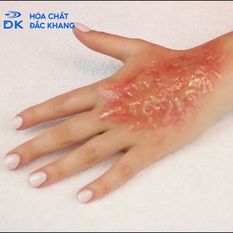 Nguy cơ và biện pháp phòng ngừa H2SO4 đặc