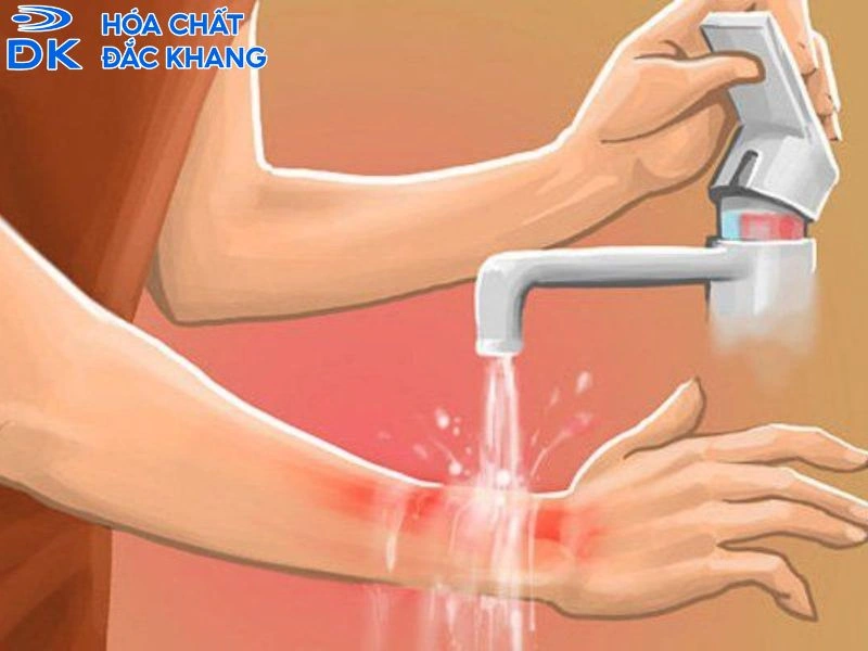 Những điều cần tránh khi sơ cứu bỏng H2SO4