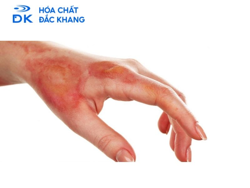 #NaOH Dính Vào Tay Có Sao Không? Cách Xử Lý An Toàn