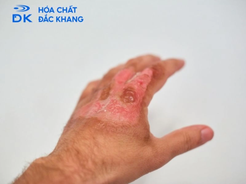 bảo quản và vận chuyển xút hạt bảo quản và vận chuyển xút hạt