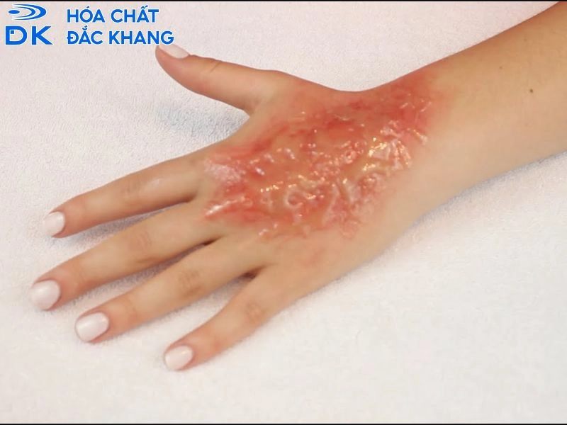 sơ cứu khi bị bỏng axit h2so4